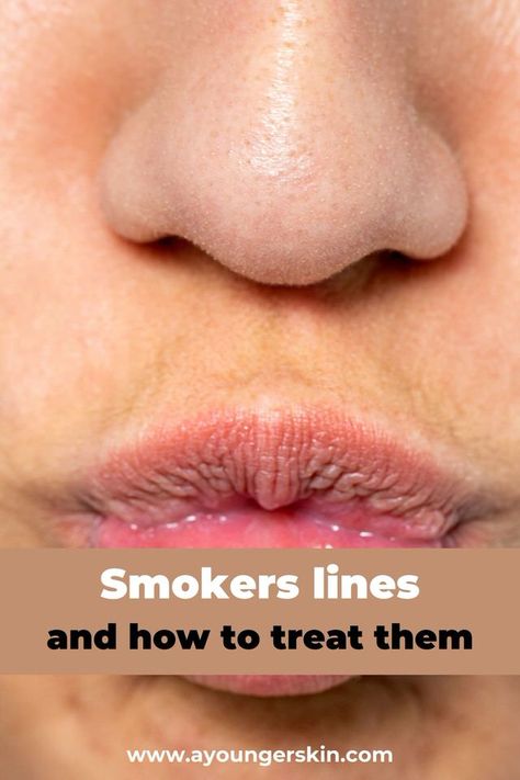 Smokers lines [why you get them and how to treat them] - A younger skin Lines Around Mouth, Face Wrinkles Remedies, Smokers Lines, Mouth Wrinkles, Wrinkle Remedies, Lip Wrinkles, Skin Care Wrinkles, Younger Skin, Face Wrinkles