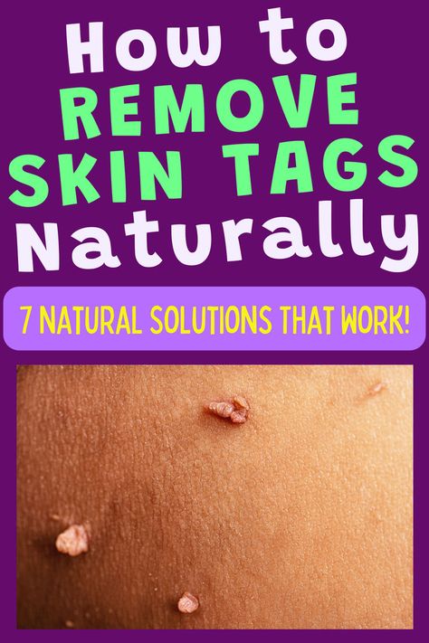 Image of skin tags. Text reads "How to remove skin tags naturally. 7 natural solutions that work!". Skin Tags Essential Oils, Skin Tags Apple Cider Vinegar, Remove Skin Tags, Apple Cider Vinegar For Skin, Remove Skin Tags Naturally, Natural Hair Growth Remedies, Tag Remover, Home Remedies For Skin, Essential Oils For Pain