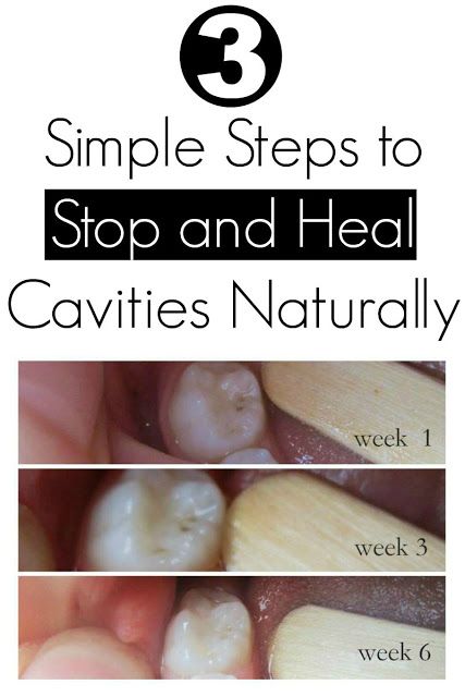 3 Simple Steps to Stop and Heal Cavities Naturally Heal Cavities Naturally, Home Remedies For Cavities, Cavity Remedy, Heal Cavities, Best Teeth Whitening, Teeth Care, Oral Health Care, Tooth Decay, Health Matters