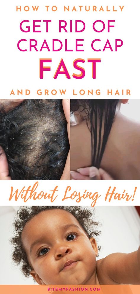 What is cradle cap? Does your baby have cradle cap? Easy, fast cradle cap removal for baby's hair. Grow baby's hair long and healthy. Naturally remove cradle cap with these easy tips.  These natural cradle cap remedies are perfect for Black baby hair care and to grow your baby's hair long. #babycare #cradlecap #growbabyshair #babyhair Natural Remedies For Cradle Cap, Natural Cradle Cap Remedy, Cradle Cap Remedies For Adults, Newborn Hair Care, How To Get Rid Of Cradle Cap, Baby Hair Growth Remedies, Baby Losing Hair, Baby Dry Scalp, Black Baby Hair