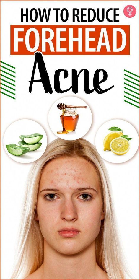 How To Reduce Forehead Acne, Forehead Acne Home Remedies, Acne On Forehead, Forehead Acne Cause, Pimples On Forehead, Back Acne Remedies, Blind Pimple, Forehead Acne, Pimples Under The Skin