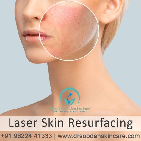 If ageing, acne, or too much time in the sun has left your face with blotches, scars, wrinkles, or lines, laser skin resurfacing may help your skin look younger and healthier. Book An Appointment Now! Whatsapp 📲 98269 44686 Call 📞 0731 4998601 #drshuken #dhlskincentre Laser Skin Resurfacing, Skin Resurfacing, Laser Skin, Book An Appointment, Look Younger, Too Much, Wrinkles, The Sun, Acne