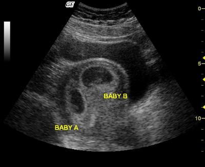 8 week- twins: This ultras was 8 weeks along. My husband and I were super shocked to find out we are having twins. These will be our 2nd and 3rd Twins Sonogram Ultrasound, Ultrasound Pictures Twins, Twin Sonogram Ultrasound, Twin Ultrasound Pictures, Identical Twins Ultrasound, Ultrasound Pictures 8 Weeks, 5 Weeks Pregnant Ultrasound, Ultrasound Prank, Twin Ultrasound