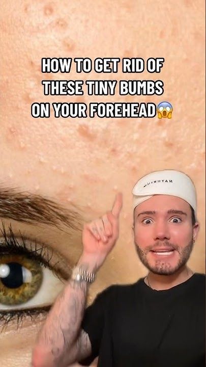 HOW TO GET RID OF FORHEAD BUMPS!😱(follow for more💗) #skincare #acne #skin #skincareroutine #beauty What Helps With Pimples, How To Get Rid Of Pimple Bumps On Face, Bumps On Face How To Get Rid Of, Face Bumps Get Rid Of, How To Get Rid Of Heat Bumps On Face, How To Get Rid Of A Cystic Pimple, Fastest Way To Get Rid Of Pimples, How To Get Rid Of Heat Bumps, Forehead Pimples Remedies