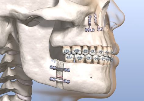 Jaw surgery, also known as orthognathic surgery or corrective jaw surgery, corrects misalignment of the jaw bones. It also helps with activities like chewing and swallowing. Orthognathic surgery can even improve your profile and facial appearance. Jaw Surgery Aesthetic, Orthognathic Surgery Before And After, Jaw Surgery Diet, Maxillofacial Surgery Wallpaper, Jaw Surgery Before And After, Double Jaw Surgery Recovery, Jaw Surgery Before And After Overbite, Facial Aesthetic, Double Jaw Surgery