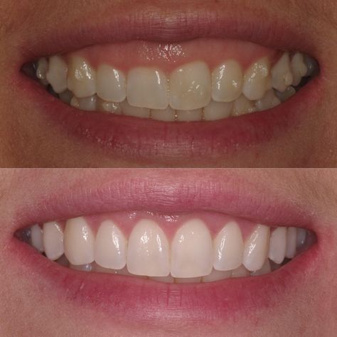 This was a diagnosis of delayed passive eruption was determined & able to treat the teeth with conservative #aesthetic #crownlengthening to achieve a #beautiful result which is stable & long lasting. #smiledesign #lovethegumsyourewith #gotoapro #gummysmile #gummysmilecorrection Orthodontic Aesthetic, Gummy Smile Aesthetic, Conservative Aesthetic, Gummy Smile Correction, Short Teeth, Teeth Aesthetic, Cosmetic Dentistry Procedures, Pretty Teeth, Jaw Surgery