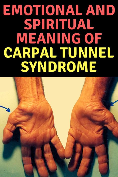 Herbs For Carpal Tunnel, Carpultunal Exercise, Carpal Tunnel Exercises After Surgery, Exercises For Carpal Tunnel Hands, How To Help Carpal Tunnel, Carpal Tunnel Release Surgery Recovery, Carple Tunnel Symptoms, Carpel Tunnel Exercises, Carpoltunal Relief Hands