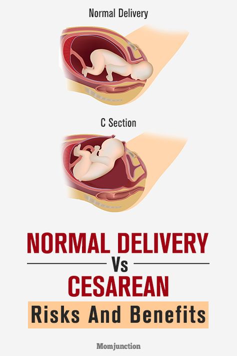 C-Section Vs. Normal Delivery: How Are They Different Normal Delivery Tips, Biological Facts, Medical Sutures, Bedding Master, Normal Birth, Birth Delivery, Cesarean Delivery, Birth Plan Template, Embossed Jewelry