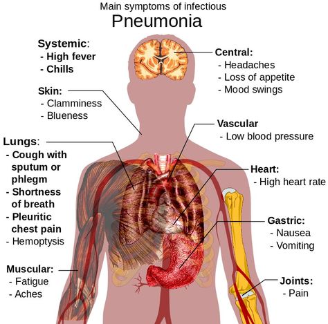 Pneumonia symptoms Pneumonia Remedies, Walking Pneumonia, Pneumonia Causes, Pneumonia Symptoms, Homeopathy Remedies, Respiratory Therapy, Med Student, Medical Knowledge, Chest Pain