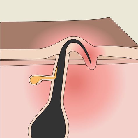 Banish the discomfort of ingrown hairs with our step-by-step guide to effectively remove ingrown hairs and prevent them from returning. How To Get Rid Of Hair Bumps, Ingrown Eyebrow Hair, Ingrown Hair Removal Videos, Get Rid Of Ingrown Hairs, Treat Ingrown Hair, Ingrown Hair Remedies, Face Mapping Acne, Bump Hairstyles, Ingrown Hair Removal