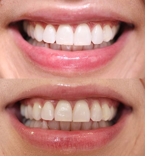 Dental Photos, Alcohol Free Mouthwash, Sensitive Teeth Remedy, Dental Photography, Teeth Whitening Remedies, Teeth Bleaching, Teeth Implants, Natural Teeth Whitening, Under Eye Bags