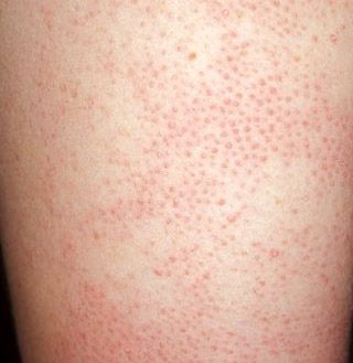 Get rid of Keratosis Pilaris on arms Skin Bumps On Arms, Bumps On Arms, Keratosis Pilaris Remedy, Patchy Skin, Nail Problems, Skin Bumps, Skin Care Guide, Keratosis Pilaris, Bumpy Skin