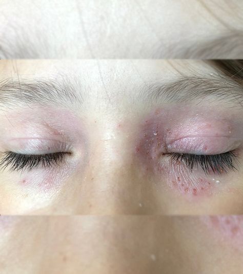 Face Allergic Reaction, Eye Irritation Remedies, Itchy Eyes Remedy, Face Rash Remedies, Skin Irritation Remedies, Home Remedies For Rashes, Dry Skin Around Eyes, Home Remedies For Face, Rash On Face