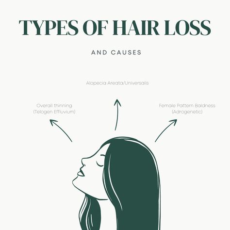 HAIR FALLING OUT? Overall Thinning (Telogen Effluvium) Female Pattern Baldness (Adrogenetic) Alopecia Areata and Universalis So What Causes Hair Loss? 🤪Stress ⚖️Hormone Imbalances 🧬Genetics 🐛Pathogens 🛢️Environmental Toxins 🧁Nutrient Deficiency To read the full article go to the link in the bio - Latest Articles. #hair #alopecia #hairlosssolution #hairlosshelp #thinninghair #thinhair #alopeciaawareness #alopeciaareata #autoimmune #autoimmunedisease Telogen Effluvium, Alopecia Awareness, Hair Falling, Female Pattern Baldness, Blemish Remover, Pattern Baldness, Midlife Women, Nutrient Deficiency, Healthy Beauty