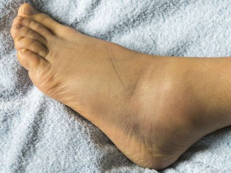 15 reasons for swelling:  There are many explanations for why a person may have swollen feet. Some causes, such as a twisted or sprained ankle, are obvious. Others might be less apparent but need urgent medical attention. These include a blood clot in the leg, heart failure, and preeclampsia. Find out when to see a doctor for swollen feet here. Ankle Sprain Recovery, Nerve Pain Remedies, Kwas Moczowy, Calf Cramps, Sistem Pencernaan, Leg Veins, Swollen Ankles, Venous Insufficiency, Swollen Legs