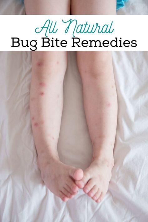 Bug Bite Remedies, Natural Bug Bite Remedy, Bug Bite Itch, Bug Bites Remedies, Bug Bite, Essential Oils Cleaning, Homemade Bath, Soothing Bath, The Sting