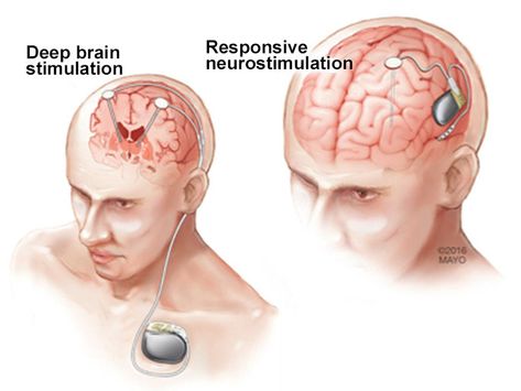 Neurology Nursing, Artificial Heart, Pie Graph, Deep Brain Stimulation, Arduino Cnc, Medical Tech, Medical Videos, Brain Stimulation, Research Methods