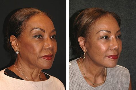 african american facelift before and after Facelift Surgery, Facelift Before And After, Acanthosis Nigricans, Sagging Cheeks, Facelift Procedure, Facial Aging, Face Lift Surgery, Nasolabial Folds, Brow Lift