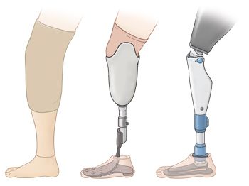 For the individuals who have prostheses for more everyday uses, however, their substitution limbs should be capable adjust to various situations and play out an assortment of functions, not simply excel in one discipline – Prosthetic leg meaning just like an actual leg. At Rinella Prosthetics, modern running edges have a particular snare shape, one of the most encouraging engineering approaches for regular prostheses is to closely model the biological design of a leg, lower leg, and foot. Leg Prosthesis Art, Prosthetic Leg Types, Prostethics Leg Drawing, Prostethics Leg, Robotic Prosthetics, Leg Prosthesis, Leg Reference, Orthotics And Prosthetics, Peripheral Nerve