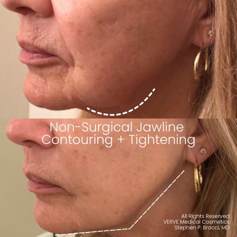 Jawline Fillers Before And After, Sculptra Filler, Sculpted Jawline, Jawline Contouring, Masseter Muscle, Double Chin Removal, Pimple Cream, Face Lift Surgery, Botox Cosmetic