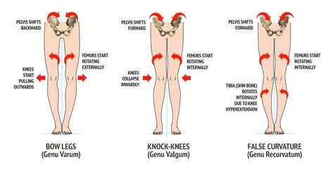 Knock knees are in part caused by over active medial hamstrings, and bowlegged by over active lateral hamstrings. Usually their opposites are under active. so in knock knees look for an under working biceps femoris, and in bowleggedness look for under working semitendinosus and/or semimembranosus.  In the case of false curvature, internal rotators of the hip and knee are overworked. Knock Knees Correction, Genu Valgum, Genu Varum, Bow Legged Correction, Tcm Traditional Chinese Medicine, Knock Knees, Knee Problem, Massage Therapy Techniques, Bow Legged