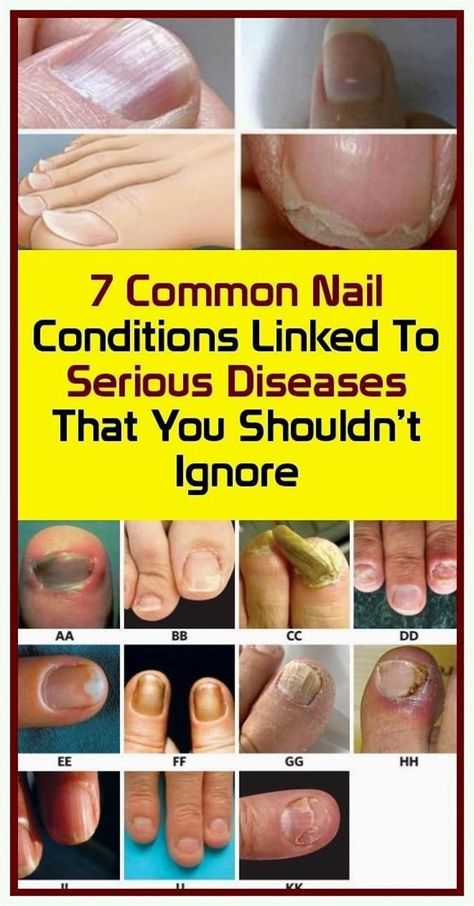 You are the reason I made it. Laudable material! Nail Health Signs, Nail Remedies, Nail Conditions, Nail Problems, Nail Infection, Fungal Nail, Ingrown Toe Nail, Toenail Fungus, Fungal Infection