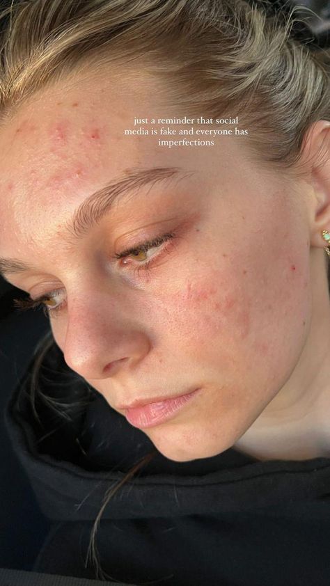 Kayli Boyle, Girl With Acne, Natural Remedies For Acne, Lemon Face Mask, Remedies For Acne, Acne Makeup, Natural Acne Remedies, Moisturizer For Oily Skin, Bare Beauty