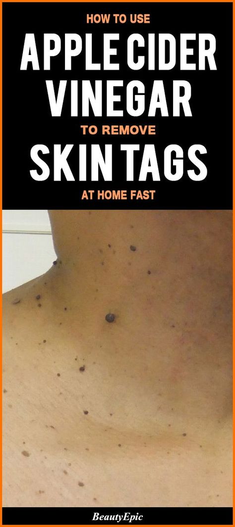 How to Use Apple Cider Vinegar to Remove Skin Tags at Home Fast Apple Cider Vinegar Skin, Apple Cider Vinegar Remedies, Remove Skin Tags, Apple Cider Vinegar For Skin, Remove Skin Tags Naturally, Skin Tags, Cold Sores Remedies, Natural Sleep Remedies, Natural Cold Remedies