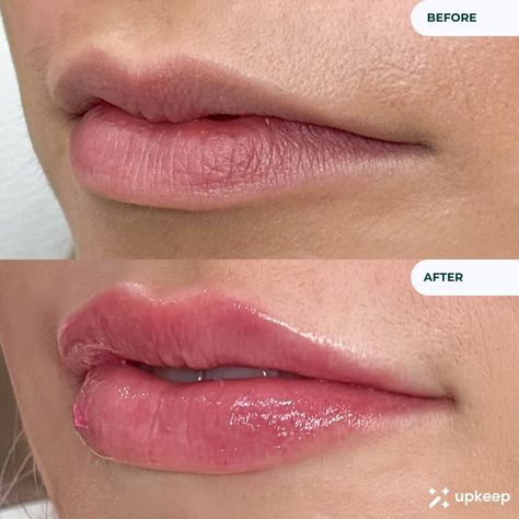 Lip Filler Before & After! One full syringe of lip filler #BookedOnUpkeep 🪄 Download the Upkeep app now to start searching for vetted medical aesthetic treatments near you! Available on iOS & Google Play! 👄 # 1ml lip filler Botox lips Lips inspiration Natural lips Restylane lips Natural Shape Ideas Lip Shapes Lip Aesthetic plump lips lip filler inspo lip injections before and after lip filler shape ideas lip filler inspiration lip fillers lip filler inspo Lip Filler On Full Lips, Lip Flip Vs Filler, Natural Lip Fillers Before And After, Half Syringe Lip Filler Before And After, 1 Ml Lip Filler Before And After, Lip Filler Natural, Lip Fillers Before And After 1ml, Lip Filler Shape Ideas, Lip Filler Before And After