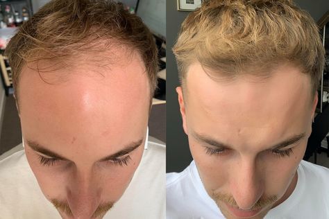 There was a time when the fight against hair loss was an uphill battle, and men would surrender to balding. But before you reach for the razor or hide your head under a hat, it’s worth considering the options. Below are three real-life stories of Aussie blokes about their journeys and how they were able […] Thinning Hair Hairstyles Men, Hair Lossing Tips Men, Thinning Hair Men, Bald Style, Balding Mens Hairstyles, Short Hair Outfits, High Forehead, Receding Hair Styles, Mens Hair Care