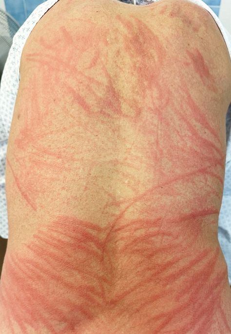 A MAN had to go to A&E with an agonising rash after eating edible mushrooms. The 72-year-old, from Switzerland, was left with a “streaky”, whip-like pattern across his back after eating shiitake mushrooms. The itchy rash — which extended over his buttocks — appeared two days before he was admitted and made it difficult for […] Cooked Mushrooms, Tired Mommy, Itchy Rash, Edible Mushrooms, Red Patch, Medicine Journal, Bacterial Infection, Shiitake Mushroom, Eating Raw