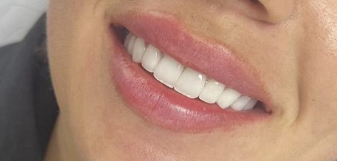 Perfect Teeth Subliminal, Perfect Smile Teeth Porcelain Veneers, Pretty Teeth Smile, Straight Teeth Smile, Straight Teeth Aesthetic, Perfect Smile Aesthetic, Teeth Whitening Aesthetic, Beautiful Teeth Smile, Bunny Teeth Smile