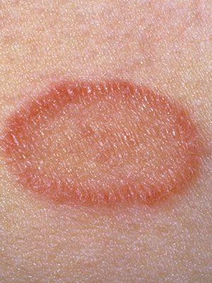 Skin conditions such as ringworm, rosacea, eczema, contact dermatitis, and seborrhea can look red, itch, and even cause pain. Learn how they are treated. Heart Diet, Natural Hair Mask, Healthy Lifestyle Quotes, Skin Condition, Juicy Lips, Skin Pores, Acne Remedies, Foreign Language, Language Learning