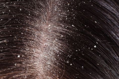 Dandruff on woman's dark hair | Premium Photo #Freepik #photo #people #medical #hair #health Mustard Oil For Hair, Diy Highlights Hair, Severe Dandruff, Coconut Milk For Hair, Olive Oil For Face, Home Remedies For Dandruff, How To Treat Dandruff, Banana Hair Mask, Rid Of Dandruff