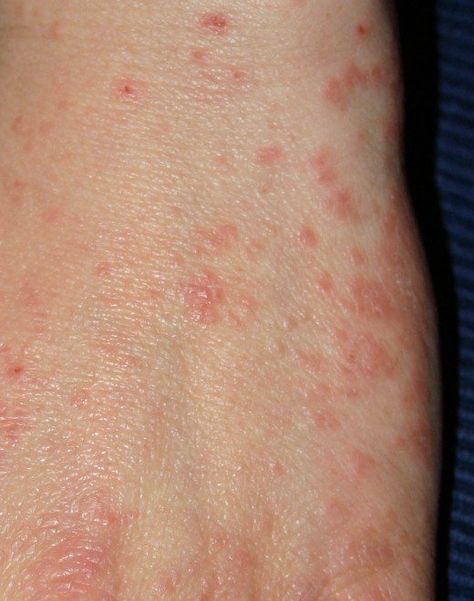 Pinned 03-19-2016:  Atypical Scabies Symptoms: Unusual Symptoms of Mites Doctors Don't Recognize Types Of Bug Bites, Clear Skin Remedies, Bug Bites Remedies, Natural Remedies For Migraines, Bug Bites, Things Under A Microscope, Homemade Remedies, Itchy Skin, Home Remedies