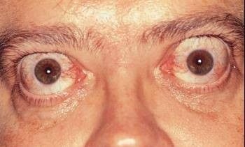 Swollen Eyelid, The Crawling Eye 1958, Eye Disorders, Eye Pain, Optic Nerve, Bulging Eyes, Heart Healthy Eating, Graves Disease, Increase Heart Rate