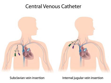 Central Venous Catheter Market Segmentation by Top Companies, Type and Region Catheter Insertion, Central Venous Catheter, Nursing Skills, Nursing Board, Interventional Radiology, Medical Marketing, Central Line, Medical Laboratory Science, Nursing School Survival