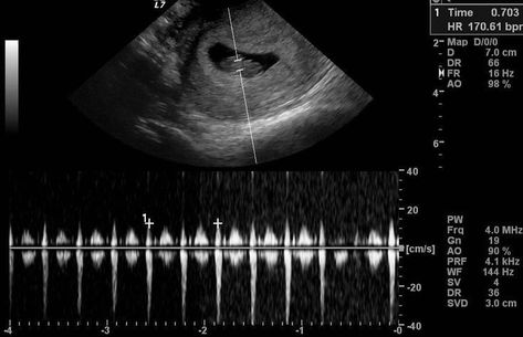 8 Week Ultrasound, Fake Ultrasound, 2 Weeks Pregnant, Ultrasound Gender, Baby Ultrasound Pictures, Baby Heart Rate, Medical Ultrasound, Pregnancy Ultrasound, First Ultrasound