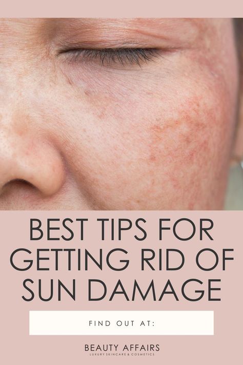 Sun Damaged Skin Remedies, Sun Damage On Face, Repair Sun Damaged Skin, Spot Remover For Face, At Home Face Mask, Women Health Care, Sun Damaged Skin, Spots On Face, Facial Sunscreen