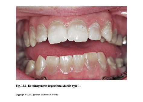 dentinogenesis imperfecta: an opalescent blue-gray to yellow-brown discoloration caused by discolored dentin shining through the translucent weak enamel; affects both primary and permanent teeth; seen in patients with osteogenesis imperfecta Osteogenesis Imperfecta, Root Canal, Yellow And Brown, Pediatrics, Blue Gray, Bones, Yellow, Blue, Quick Saves