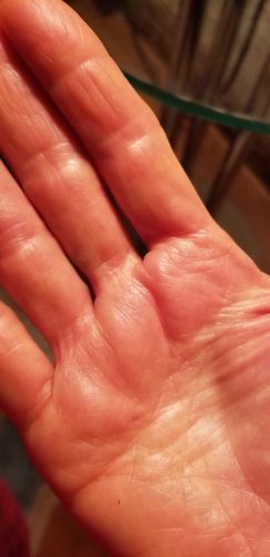 "I have dupuytren in the palms of my hands. The right ring finger is tight and sometimes there is a burning sensation at the base of that finger. I used the cream for almost 3 weeks and it has reduced the tightness and burning. I am pl..." - Ruth C. Burned Finger, Dupuytren's Contracture, Baby Sleep Schedule, Hand Burn, The Palms, Cleanse Your Body, Natural Cream, The Cream, Ring Finger