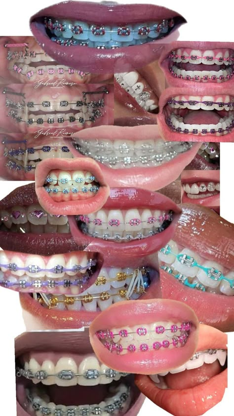 January Braces Colors, Western Braces Colors, Soft Foods To Eat With Braces, Navy Blue Braces Teeth, Braces Before And After Overbite, Powerchain Braces Color, Braces Colors Ideas Dark Skin, Light Pink Braces, Orange Braces