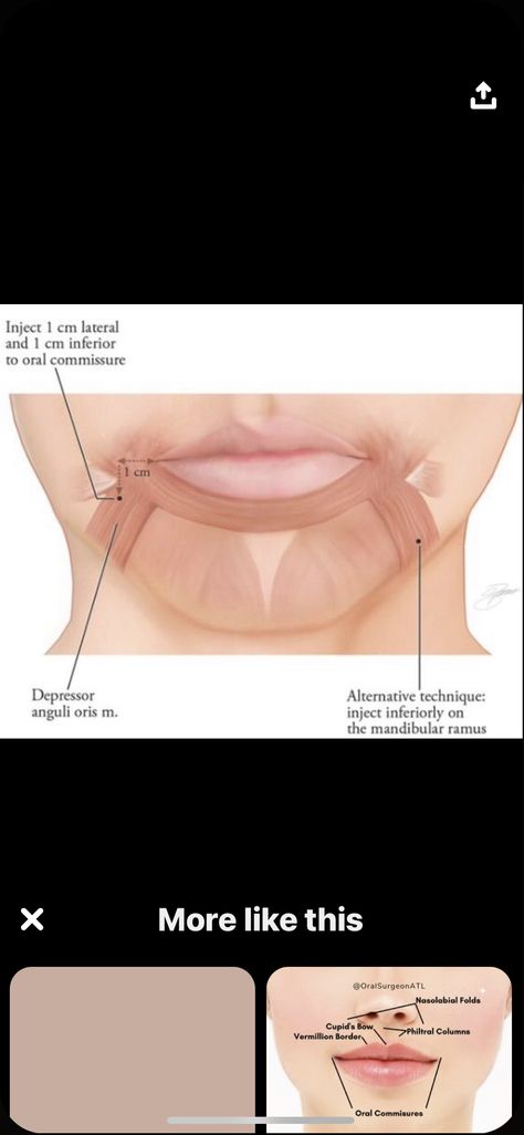 Botox Placement Chart, Botox Migraine, Botox Injection Sites, Facial Injections, Botulinum Toxin, Skin Anatomy, Aesthetic Dermatology, Botox Face, Dental Photography