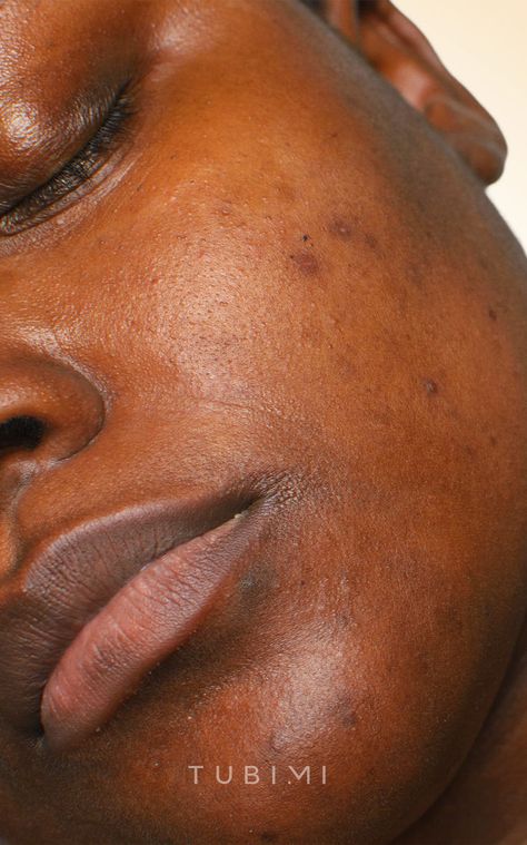 Ever wondered where these stubborn dark spots and brown patches in your face come from? Well, it is called hyperpigmentation and it happens when your skin produces too much melanin. Read about the causes and treatments for dark spots in our latest blog post. In Your Face, Dark Spots, Your Skin, Too Much, Blog Post, Skin