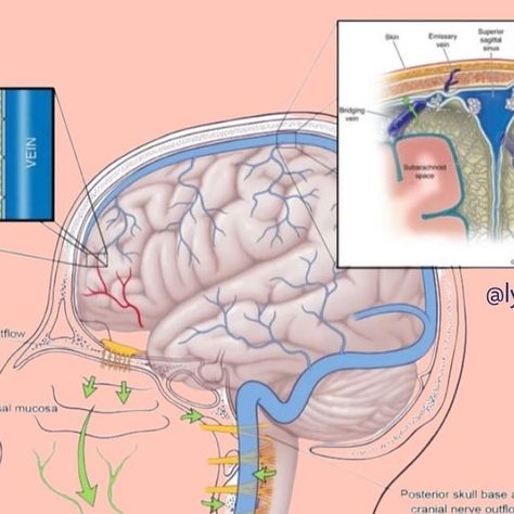 Lymph Love Club | Lymph Literacy Advocate on Instagram: "If you have a loved one suffering from cognitive decline, this post is for you. The lymphatic system plays a role in the daily clearance of metabolic waste products and toxins from the brain, including those associated with dementia and other neurodegenerative diseases. The glial-lymph system primarily “flushes” when we’re in deep REM sleep, and relies heavily on the movement of cerebrospinal fluid (CSF) through perivascular channels. This forms the “glymphatic” network where harmful substances are channelled out of the brain towards the lymph vessel in the outer layers of the meninges and perineural sheaths of the cranial and spinal nerves. Lymph from the brain passes through the deep cervical lymph nodes in the neck, gravita Cervical Lymph Nodes, Cognitive Decline, Lymph Vessels, Spinal Nerve, Lymph System, Cerebrospinal Fluid, Rem Sleep, Love Club, Lymph Nodes