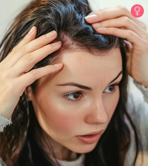 Often caused by an ill-fitting hat or winter weather, a scab on the scalp can be painful and embarrassing. So, how do you treat scabs on the scalp? Click here. Dry Patches On Scalp, Scalp Picking, Scabs On Scalp, Scalp Pimples, Hairstyle For Baby Girl, Scalp Scabs, Quotes About Goals, Scaly Scalp, Pimples On Scalp