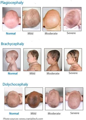 diagram of different levels of flat heads on baby Baby Head Shape, Flat Head Syndrome, Nursing School Essential, Baby Routine, Child Health, Newborn Baby Tips, Newborn Mom, Nursing School Survival, Medical School Essentials