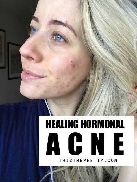 Cystic Hormonal Acne, How To Help Hormonal Acne, How To Clear Up Acne, Hormone Acne, Hormonal Acne Skincare Routine, Clear Hormonal Acne, Postpartum Acne, Medical Remedies, Hormonal Acne Supplements