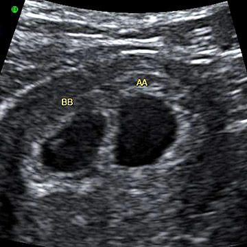 Fetal size: Length, 1/6  to 1/4 of an inch, crown to rump. Weight, still too small to measure.                         Fetal development milestones: This week the babies are registering fetal heartbeats. Blood is pumping through their hearts. There are now two distinct amniotic sacs and the twins' heads, legs, and umbilical cords are forming.                         What you're seeing: Although this may not look like much, these circles show two distinct gestational sacs -- twins! With a sing... Twin Ultrasound, Twins Ultrasound, Baby Weeks, Baby Ultrasound, Early Pregnancy Signs, Twin Baby Girls, Ultrasound Pictures, Fetal Development, Baby Stage