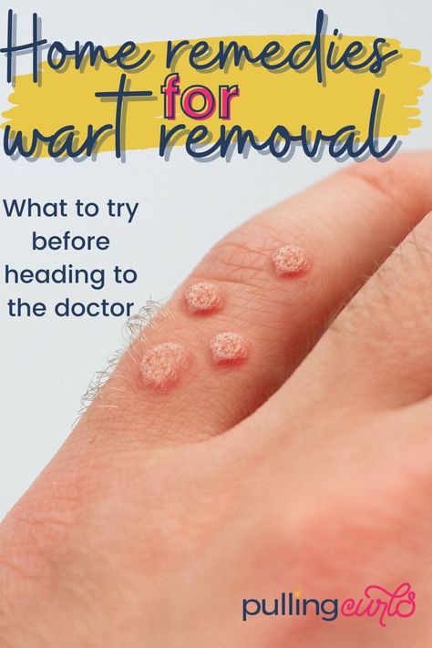 How to get rid of warts. These easy remedies for kids can be done at home, for different types of warts. This removal is DIY meaning you can get at the root of what causes them. My son got rid of plantar warts using this. And it can also help on your hand. We used essentials oils for wart removal. It was an easy way to get rid of them, so you don't have to worry. via @pullingcurls How To Treat Warts, Diy Meaning, Different Types Of Warts, Wart Remedies, Plantar Warts, Types Of Warts, Home Remedies For Allergies, Home Remedies For Warts, Warts Remedy